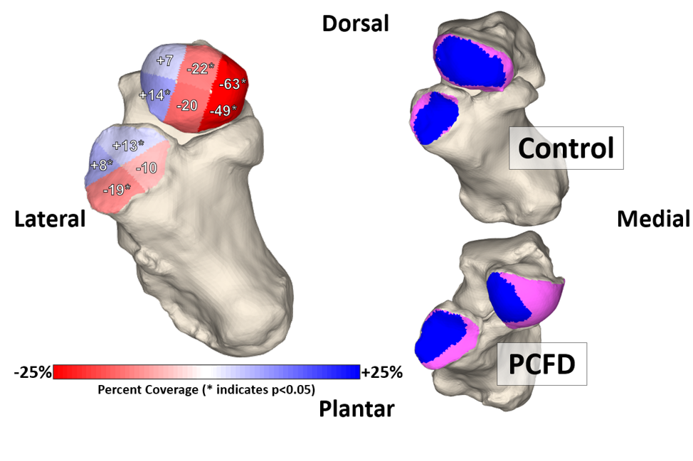 Progressive Collapsing Foot Deformity (Flatfoot) Orthopedic